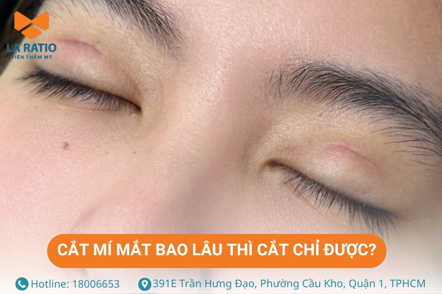 Cắt mí mắt bao lâu thì cắt chỉ? Khoảng 5 - 7 ngày sau khi cắt mí Cắt mí mắt bao lâu thì cắt chỉ? Khoảng 5 - 7 ngày sau khi cắt mí