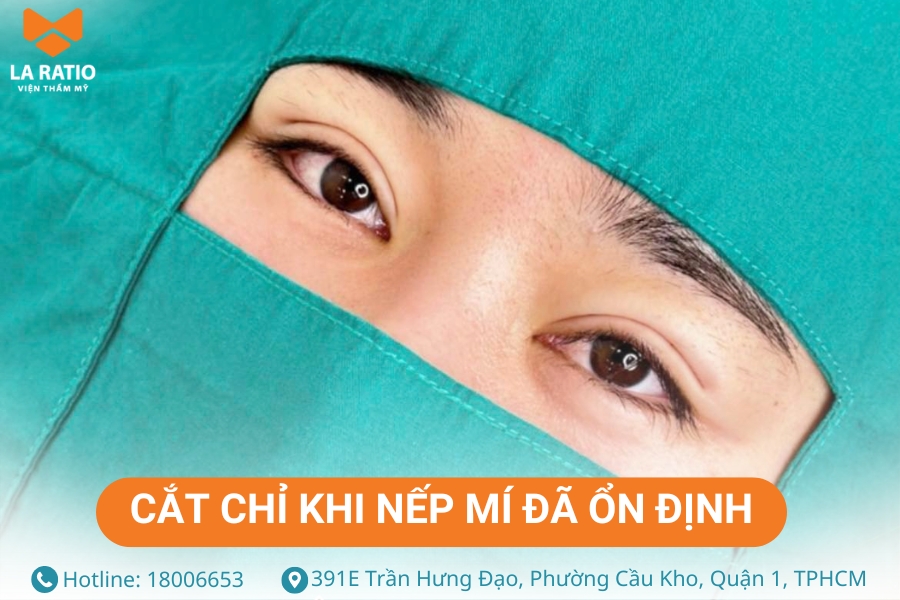 Chỉ cắt chỉ mí mắt khi nếp mí đã ổn định Chỉ cắt chỉ mí mắt khi nếp mí đã ổn định