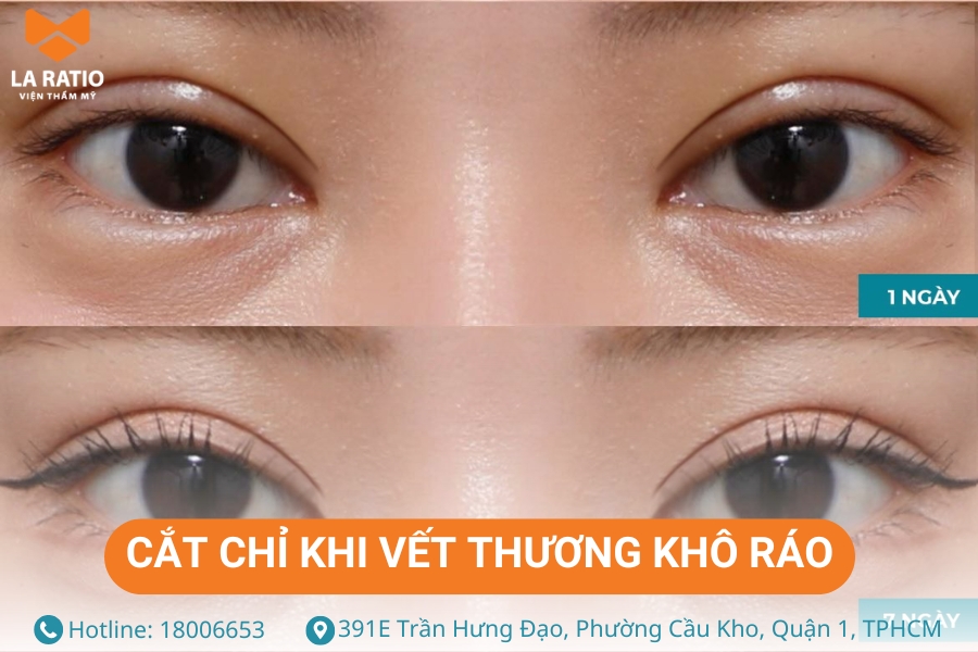 Cắt mí mắt bao lâu cắt chỉ? Khi vết thương khô ráo, bạn mới có thể cắt chỉ mí mắt Cắt mí mắt bao lâu cắt chỉ? Khi vết thương khô ráo, bạn mới có thể cắt chỉ mí mắt