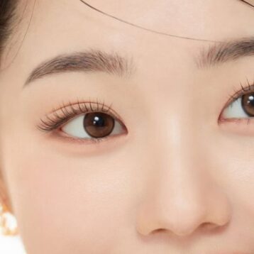 Cắt mí ILID tại Viện thẩm mỹ La Ratio