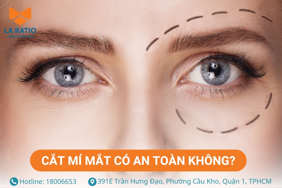 Cắt mí mắt là tiểu phẫu thẩm mỹ tương đối an toàn