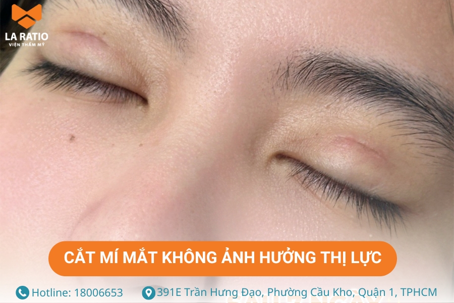Cắt mí mắt không ảnh hưởng đến thị lực nếu được thực hiện tại cơ sở thẩm mỹ uy tín