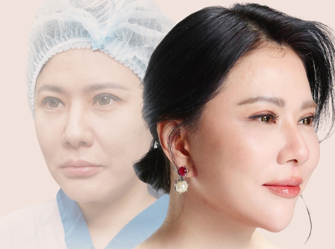 dịch vụ căng da mặt smas face có gì nổi bật