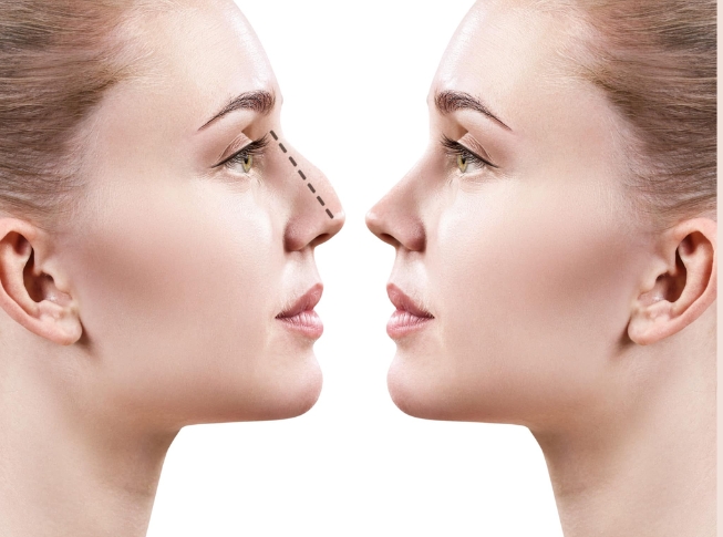 dịch vụ mài gồ xương mũi tại la ratio có gì nổi bật