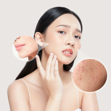 điều trị mụn tại la ratio