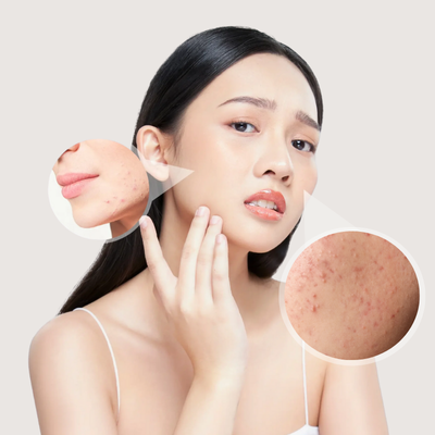 điều trị mụn tại la ratio