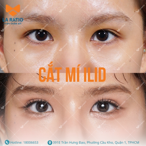 hình ảnh trước và sau khi cắt mí mắt ilid tại la ratio