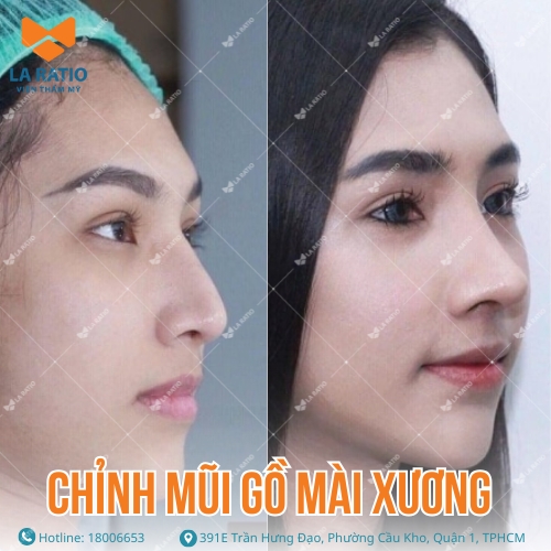 hình ảnh khách hàng trước và sau khi chỉnh mũi gồ mài xương tại la ratio