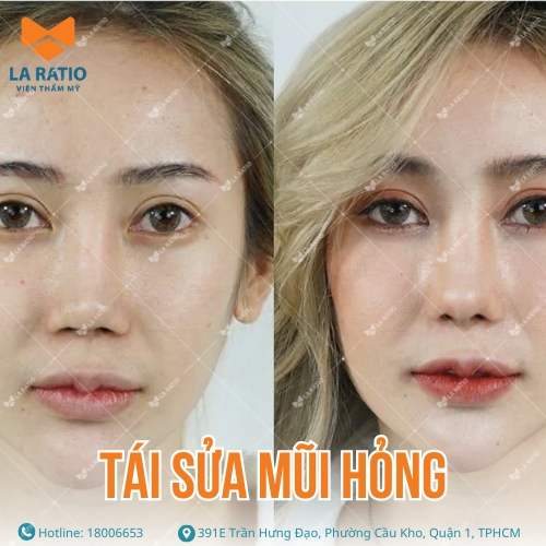 hình ảnh khách hàng trước và sau khi tái sửa mũi hỏng tại la ratio