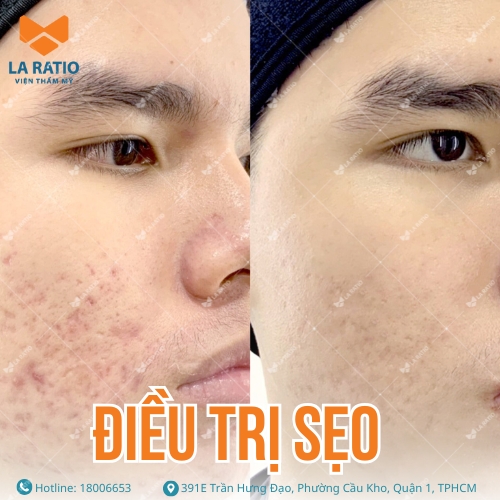 hình ảnh trước sau trị sẹo hiệu quả tại la ratio