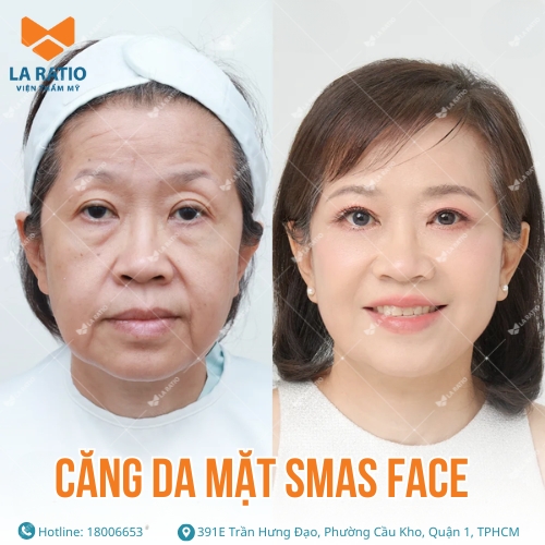 hình ảnh trước và sau khi căng da mặt tại viện thẩm mỹ la ratio