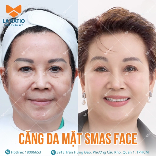 hình ảnh trước và sau khi căng da mặt tại viện thẩm mỹ la ratio
