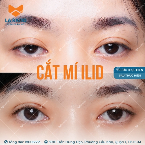 hình ảnh trước và sau khi cắt mí mắt ilid tại la ratio