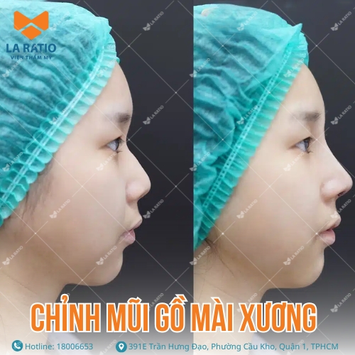 hình ảnh trước và sau khi chỉnh mũi gồ mài xương tại la ratio