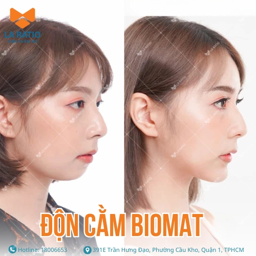hình ảnh trước và sau khi độn cằm biomat tại la ratio