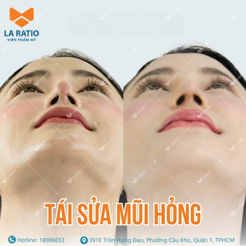 hình ảnh trước và sau khi tái sửa mũi hỏng tại la ratio