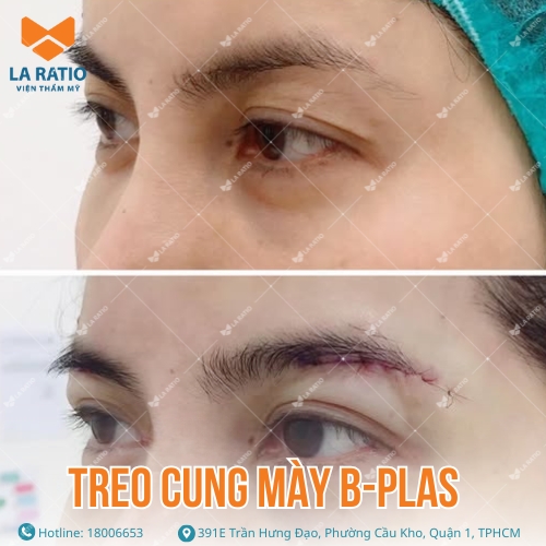 hình ảnh trước và sau khi treo chân mày b plass tại la ratio