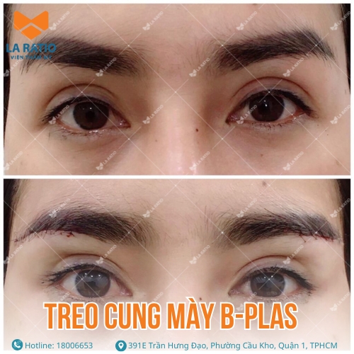 hình ảnh trước và sau khi treo cung mày b plass tại la ratio