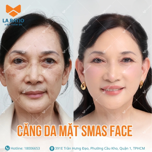 hình trước và sau khi căng da mặt smas face