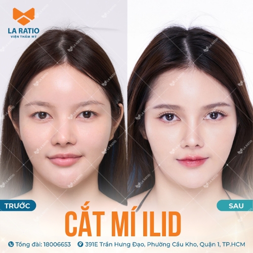 hình trước và sau khi cắt mí mắt ilid tại la ratio