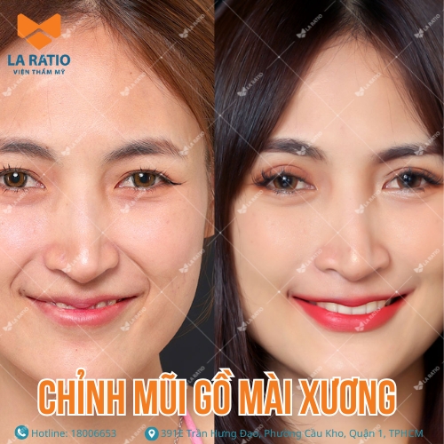 hình trước và sau khi chỉnh mũi gồ mài xương