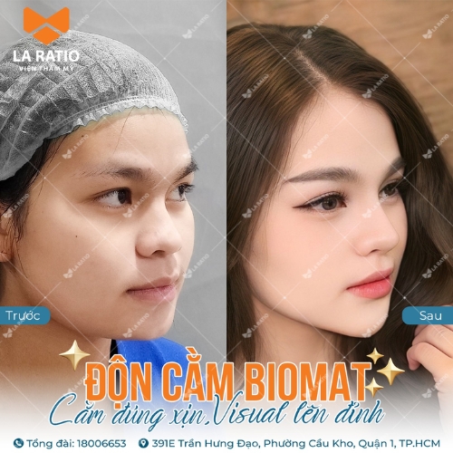 hình trước và sau khi độn cằm biomat