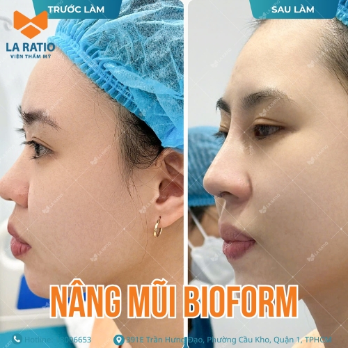 hình trước và sau khi nâng mũi bioform