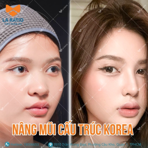 hình trước và sau khi nâng mũi cấu trúc korea