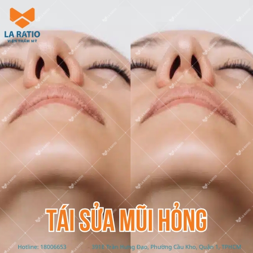 hình trước và sau khi tái sửa mũi hỏng