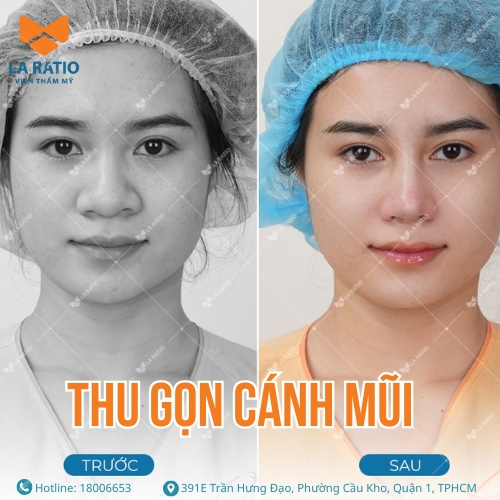hình trước và sau khi thu gọn cánh mũi