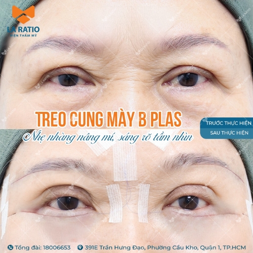 hình trước và sau khi treo cung mày b plas