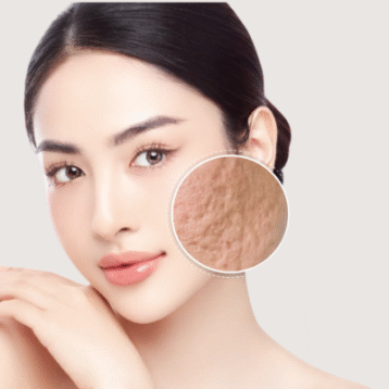 trị sẹo rỗ tại la ratio