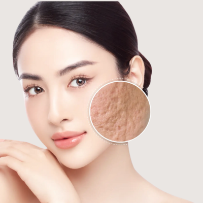 trị sẹo rỗ tại la ratio