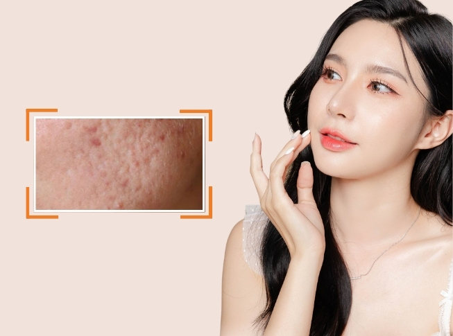 ưu điểm điều trị sẹo rỗ tại la ratio