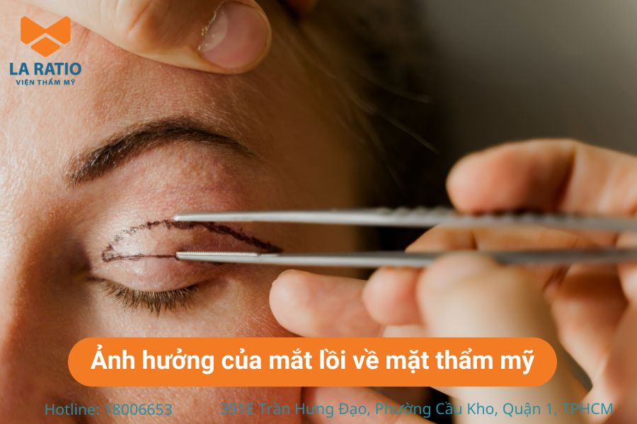 Mắt lồi gây ảnh hưởng nghiêm trọng đến tính thẩm mỹ