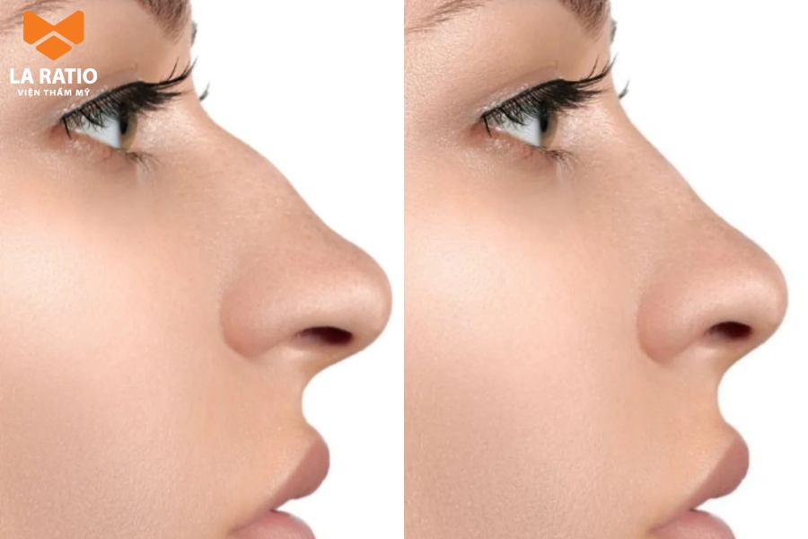 Mũi gãy là dáng mũi xấu khiến nhiều người cảm thấy tự ti