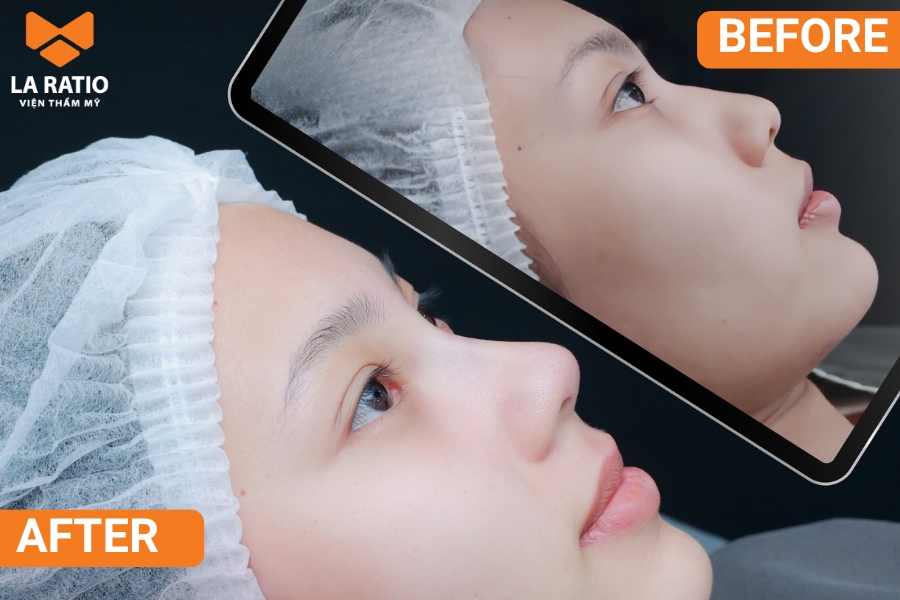 Nâng mũi cấu trúc giúp khắc phục mũi khoằm, mũi chim ưng lâu dài