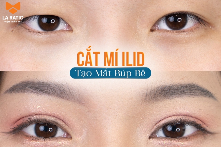 Cắt mí tạo hình đôi mắt hai mí rõ nét