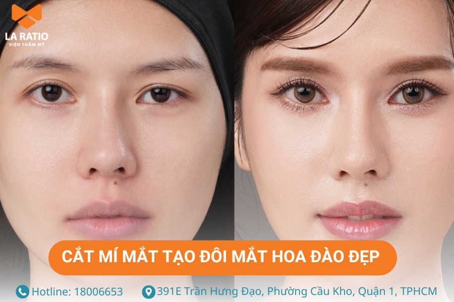 Cắt mí mắt – giải pháp giúp bạn sở hữu đôi mắt to tròn, hài hòa và sắc nét Cắt mí mắt – giải pháp giúp bạn sở hữu đôi mắt to tròn, hài hòa và sắc nét