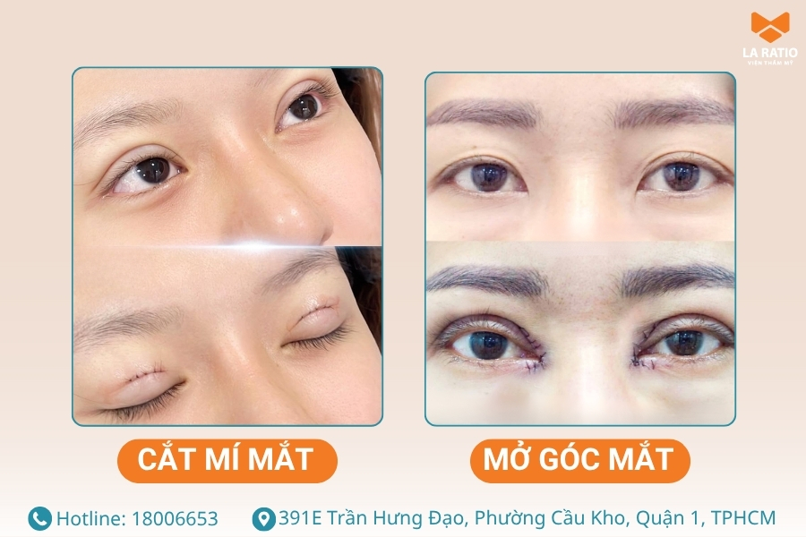 Cắt mí mắt và mở góc mắt là 2 kỹ thuật tạo hình thẩm mỹ mắt khác nhau
