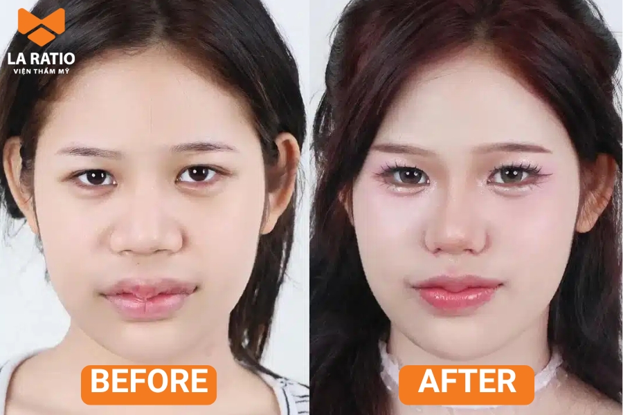 Nên chỉnh sửa mũi cà chua khi dáng mũi này ảnh hưởng đến thẩm mỹ và sự tự tin của bạn