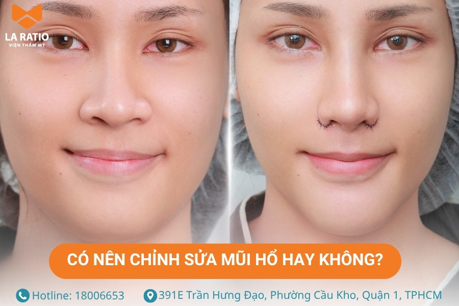 Nếu cảm thấy chưa hài lòng với dáng mũi hổ, bạn có thể nâng mũi để cải thiện Nếu cảm thấy chưa hài lòng với dáng mũi hổ, bạn có thể nâng mũi để cải thiện