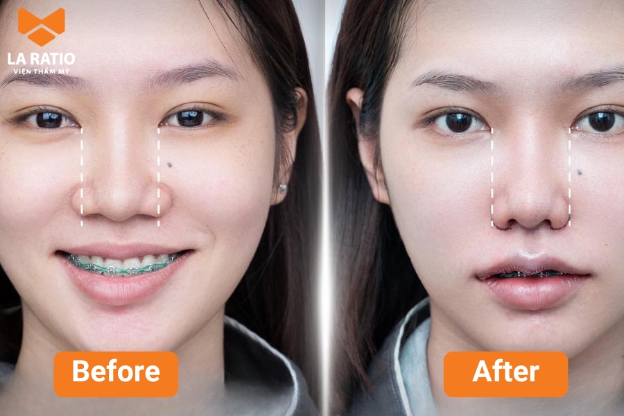 Có nên chỉnh sửa mũi trâu hay không tùy thuộc vào mong muốn của mỗi người