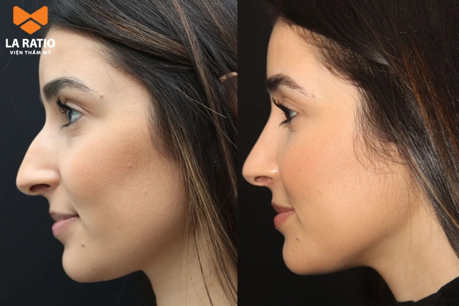 Mũi khoằm không phải là dáng mũi đẹp lý tưởng