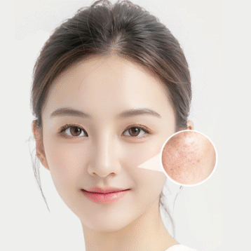 điều trị nám tại la ratio