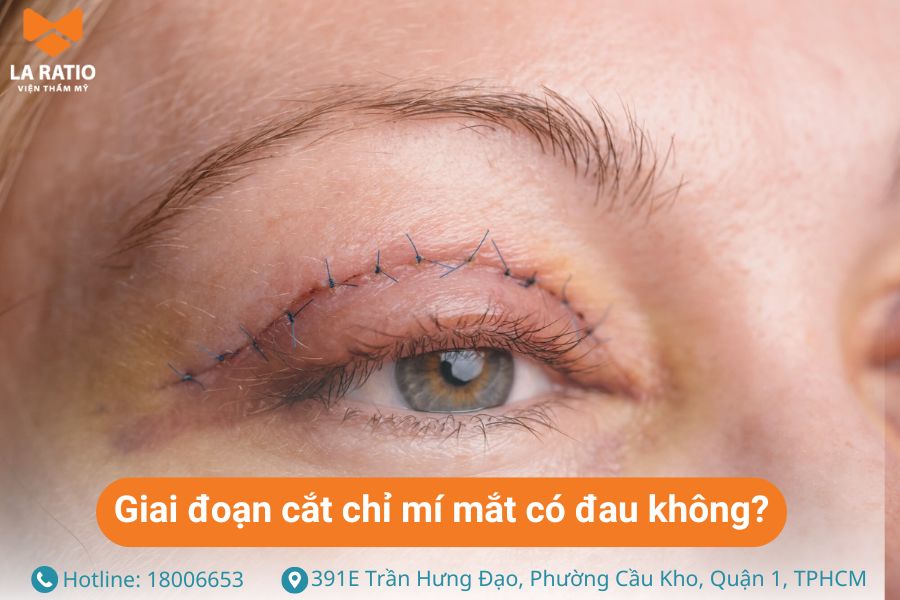 Cắt chỉ mí mắt có đau không? Hầu như là không đau, chỉ cảm thấy hơi nhói Cắt chỉ mí mắt có đau không? Hầu như là không đau, chỉ cảm thấy hơi nhói