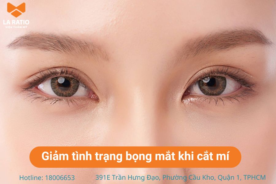 Cắt mí mắt có thể giúp làm giảm tình trạng xuất hiện bọng mắt