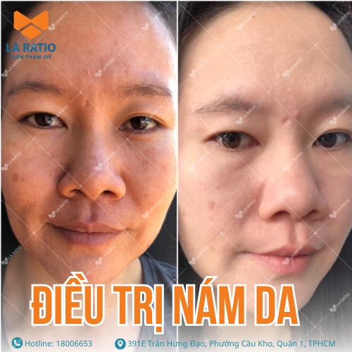 hình ảnh trước sau trị nám da hiệu quả tại la ratio