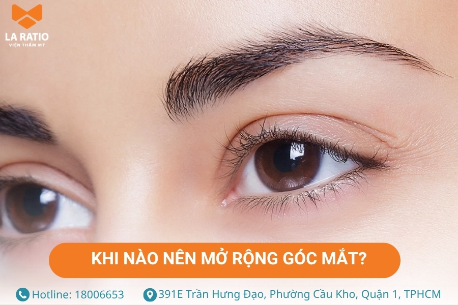 Khi nào nên lựa chọn phương pháp mở rộng góc mắt