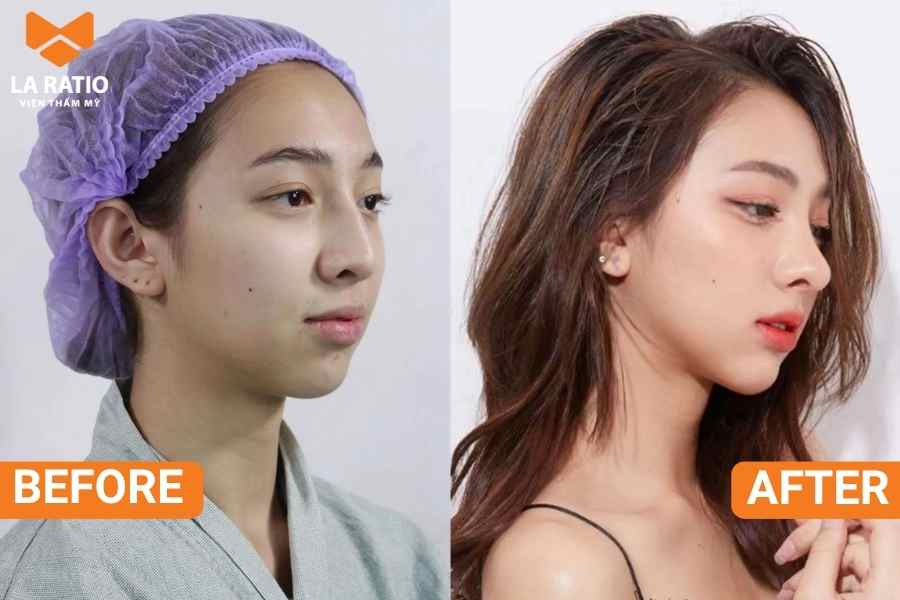 Nâng mũi cấu trúc can thiệp vào cấu trúc bên trong mũi, giúp loại bỏ sống mũi gồ và các khuyết điểm mũi 